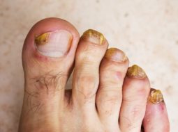 antifungal for toenail fungus