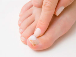 Fungal Nail Infection Best Treatment