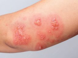 is shingles contagious